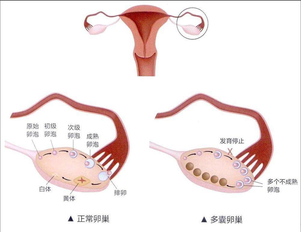 滤泡会发育,但最后只会有一颗卵子成熟排出,而患有多囊卵巢的女性虽然