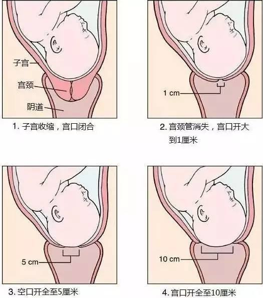 试管婴儿分娩注意事项有哪些？分娩时可不可以做体位运动插图